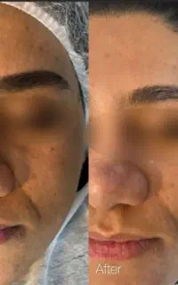جشنواره تابستانه فیشال هایفو کربوکسی لیزر ونوس