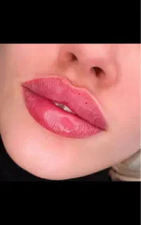 ژل لب گونه چانه بوتاکس جوانساز