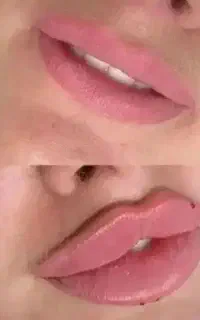 فیلر لب، ، فول فیس،کانتورینگ