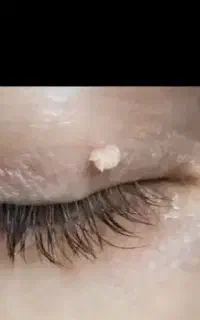 تخفیف استثنایی خال برداری درمطب دکتر کریمی تیموری