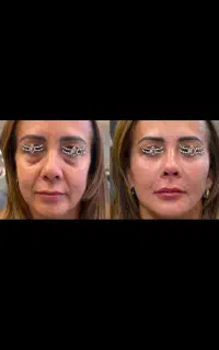 بینی/ سربالاکردن فقط یک جلسه/نیم بها بمدت ۳روز