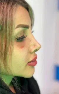 آف جراحی بینی فقط ۲۲تا۳۰ اهواز انجام میشه