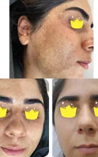 رفع کک مک پلک مزونیدلینگ تخفیف ویژه
