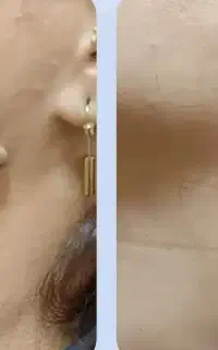 از شر خال‌های گوشتی خلاص شو