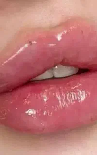 تزریق ژل و بوتاکس