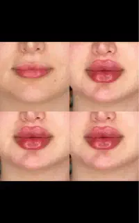 ژل وبوتاکس ولیزر(جشنواره ۵۰ درصدی)
