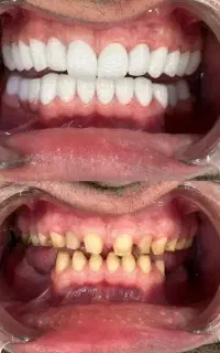 دندانپزشکی کامپوزیت روکش با ٪۳۰٪ تخفیف ویژه