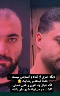 کاشت مو شیرازی  اقساطی خانم ها و آقایان
