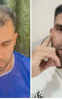 کاشت مو VIP شیراز در یزد،با ۲۱ سال سابقه درخشان