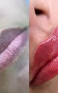 تخفیف میلیونی شیدلب فیبروز،خط چشم بدون درد