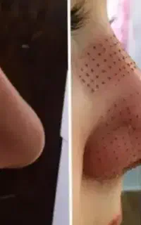 چربی سوزی
