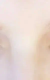 کاشت مژه والیوم