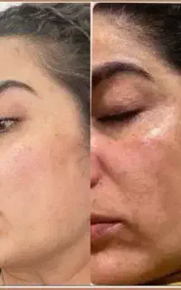«دکتر کامبیز محمدپور»آفر50%لیزری،سفیدکردن صورت بدن