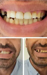 دندانپزشک‌عمومی‌وزیبایی‌دربوکان.ایمپلنت،کامپوزیت..