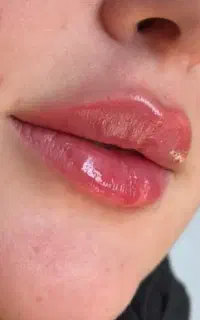 مزو بوتاکس فیلر ژل