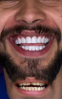 دندانپزشکی کامپوزیت لمینت جرمگیری روکش