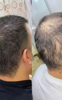 کاشت هم نمیتونه این نتیجه رو بهت بده