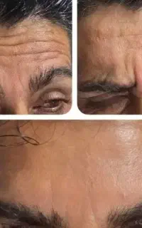 آموزش تزریق بوتاکس و ژل