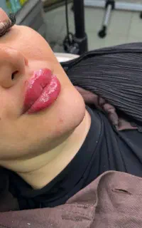 آف ژل بوتاکس مزو