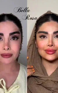 تزریق فیلر بوتاکس آنزیم مزوتراپی