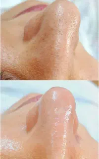 فیشیال پوست صورت/جوانسازی/جوش/منافذ/چروک