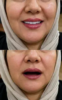 دندان مصنوعی طرح لمینت با اقساطی و بدون بهره