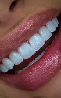 جشنواره ویژه کامپوزیت دندان