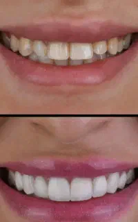 خدمات دندان با اقساط بدون پیش پرداخت بدون بهره