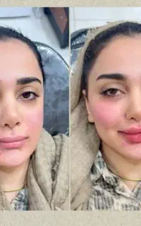 جشنواره آموزشی حرفه ی ژل+بوتاکس+آنزیم مناسب