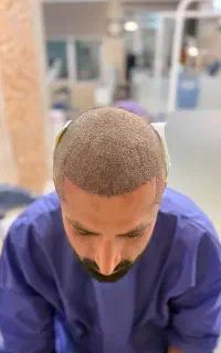کاشت مو،ریش و ابرو توسط تیم پزشک متخصص