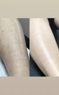 لیزر مو با دستگاه شاتی