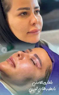 برداشتن پلک بالاوپایین (بلفاروپلاستی)