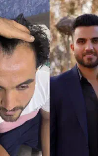 کاشت مو ابرو ریش با شرایط اقساطی