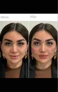 کاشت ابرو فیلر بوتاکس فیلربادی