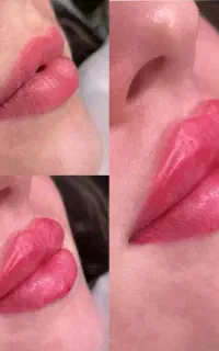 تزریق فیلر و بوتاکس در صدرا
