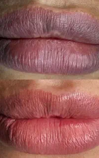 شیدینگ لب و رفع تیرگی لب در کلینیک دکتر رهنما