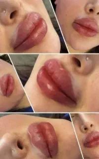 ژل و بوتاکس و مزو سر و صورت نخ فول فیس50/۰تخفیف