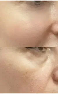 مدل تزریق فیلر