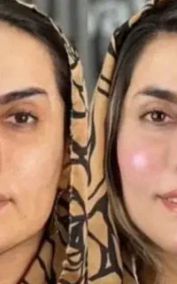 تزریق بوتاکس وژل،مزوتراپی،جوانساز،