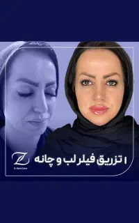 بوتاکس مصپورت۹۵۰،لیفت نخ آنزیم بینی فیلر ژل
