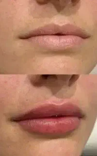 جشنواره ژل ، بوتاکس، پی ار پی ، با 60% تخفیف