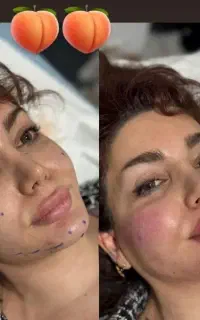 تزریق ژل(فیلر) بوتاکس