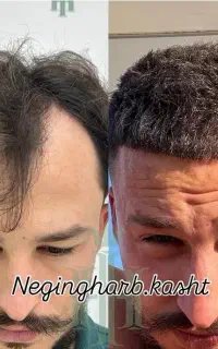کاشت مو تضمینی 22.900بدون جراحی