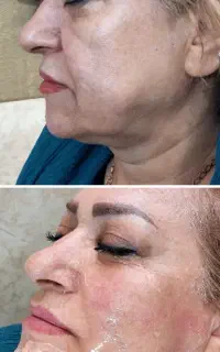 جوانسازی با هایفوتراپی،درمان کک و مک و جای اسکار