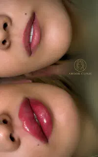 جشنواره ژل و بوتاکس فیلر توسط خانم دکتر چابکی