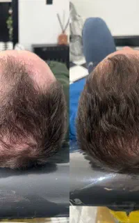 بررسی تخصصی فولیکول