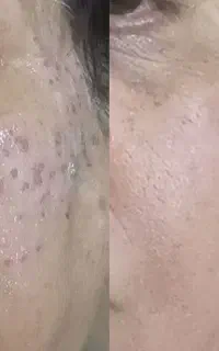 خدمات زیبایی ،فیشال تخصصی ، خالبرداری تخصصی