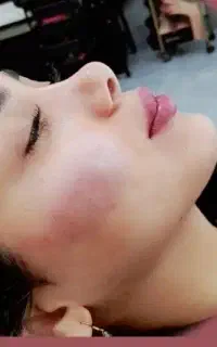 مدل واسه ژل و بوتاکس