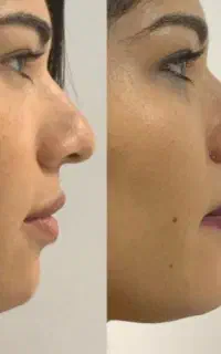 بدون عمل بینی تو خوش فرم کن