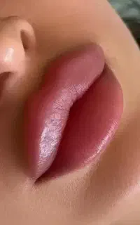 انواع تزریق بدن و صورت فیلربادی ژل و بوتاکس